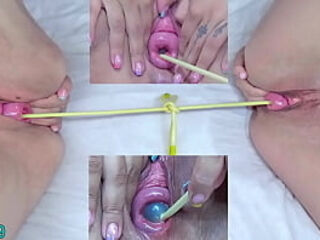 Prolapsed Cervix Lesbians at the same time